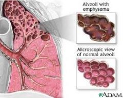 Destruction of alveolar walls
Elastic fibers that hold bronchioles open are destroyed, so that they collapse during exhalation, not letting air escape from the lungs.
Increased dead space
Primarily caused by smoking