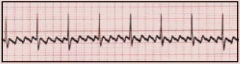 - An ectopic, very rapid atrial tachycardia
- Atrial rate of 250-350 beats per minute; ventricular rate dependent upon AV node conduction
- Saw-tooth shaped P waves (also known as atrial flutter waves)
- Occurs with valvular disease (especially...