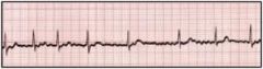 - Common arrhythmia where the atria are depolarized between 350 and 600 x/min
- ECG shows characteristically irregular undulations of ECG baseline without discrete P waves
- Occurs in healthy hearts and in patients with coronary artery disease, ...
