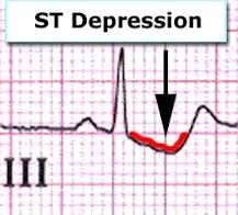- A depressed ST segment is a sign of subendocardial ischemia, but also can be due to digitalis toxicity or hypokalemia
- The segment is evaluated relative to isoelectric baseline at 0.08 seconds after the J point
- Deviations from isoelectric b...