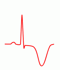 - Occurs hours or days after an MI as the result of a delay in repolarization produced by the injury
- May also occur with R and L bundle branch blocks, after a CVA, and as a normal juvenile T wave pattern in children and some adults