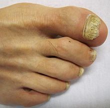 Fungal infection of toenails and nailbeds