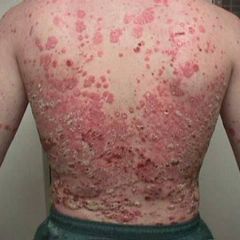 Chronic autoimmune disease
Skin cells accumulate in raised red patches on the skin