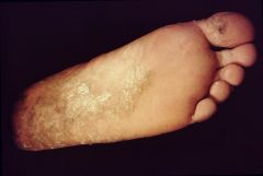 Athlete's foot
Superficial fungal infection which causes epidermal thickening and scaly skin appearance.