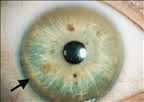 Rare inherited disorder - autosomal recessive
Defect in body's ability to metabolize copper
Accumulates within brain, liver, cornea, kidney, and other tissues.
Symptoms normally appear by age 6 with a ring around iris.