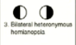 BITEMPORAL HETERONYMOUS HEMIANOPSIA