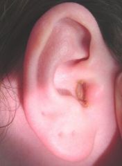 This Pt's CC = Otalgia.  The Pt tells you that she just needed to use q-tips to clean her ears and that the amber d/c was wax.  What is your Dx and what PE will r/in or r/o?