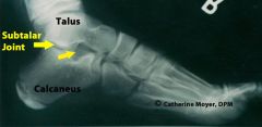- between talus & calcaneous


 


- synovial joint surrounded by its own capsule


 


- bony make up gives it its stability


 


- pronation & supination occurs here


- 6 degrees pronation


- 12 degrees supination