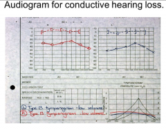 Conductive or sensorineural hearing loss?