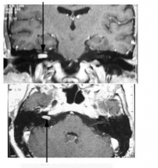 What is the arrow pointing to here? 
 
How would this present differently if it were a meningioma?