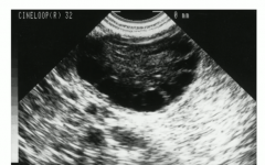 2 of the following 3 are necessary for diagnosis
 
- oligo/anovulation
- hyperandrogenism,
- polycystic ovaries on ultrasound
