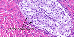 Ovarian tumor that's benign, solid, encapsulated, and looks like transitional epithelium of the bladder with "coffee bean" nuclei