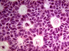 Call exner bodies - eosinophilic fluid-filled spaces between granulosa cells
 
Further clues:
malignant, secretes  estrogen/progesterone/inhibin 
 
-can cause endometrial hyperplasia or percocious puberty