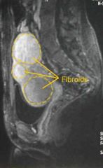 What is a Uterine fibroid?
(leiomyoma, myoma, fibromyoma)