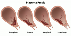  
It's abnormal placement of the placenta.
 
Placenta attaches over or near the cervix so we can get a "preview" of the placenta in the cervical os
 
Complete is the worst, where it covers the cervix completely and baby can't be delivered throu...