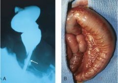 If a pt w/ Hirschsprung disease does not undergo surgical removal of the obstruction (arrow), what complications may arise?