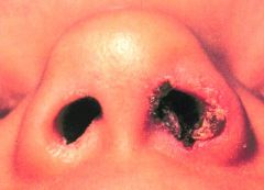 Your Pt has a Hx of recent nasal packing to stop epistaxis.  Visual examination of the nose reveals this.  What is it and why did they get it?