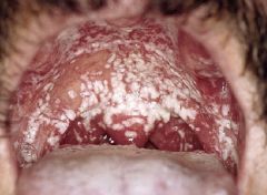 Pt presents with creamy, white, curd-like patches over erythematous mucosa.  The rub off the mucosa easily.  What is your Dx and how do you Tx?