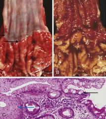 What morphologic changes occur in Barret esophagus?


 


(bottom img)