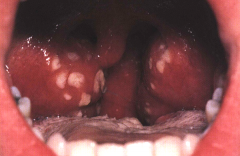 Pt presents with Fever, halitosis, Cervical LAD, Odynophagia and pharyngeal exam reveals this.  What is the most likely Dx?