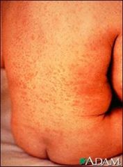 This Disease causes a maculopapular (little tin blisers)  rash