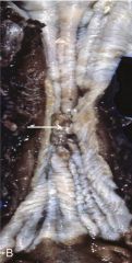 Squamous cell carcinoma occurs in the middle 3rd of the esophagus presents as ulcer w/ stricture (50% of time- img).  What sxs does it produce?
