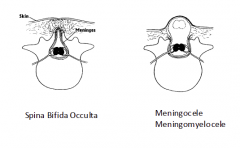 1. most common, asymptomatic
2. Accumulation of CSF in the meningeal spaces surrounding the spinal cord
3. If in meningocele the cord is also herniated, the
condition is called meningomyelocele. These defects result from abnormal formation of th...