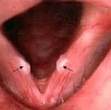 Dx: Vocal Cord Nodules
Tx: refer to specialist for voice modification/speech therapy & surgical removal