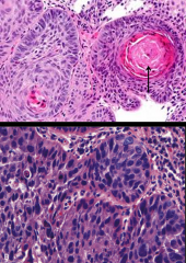 moderate w/ dysplasia (bottom) to well differentiated squamous cells (top) w/ keratin pearl (arrow) formation