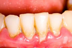 During your oral exam, you discover pale, yellow, sticky deposits on the teeth.  What do you tell your Pt and how do you educate them?