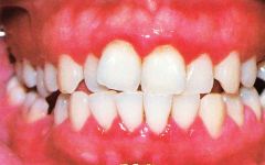 Pt's oral exam reveals this.  Pt complains that gums bleed during flossing and that they are tender.  Dx?