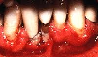 This Pt has poor oral hygiene and that has caused the periodontal dz.  Correct or Incorrect & why?