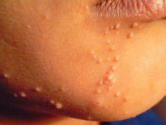 This disease of the skinMost commonly in children causes smooth wax nodules on the face, trunk and limbs that are filled with fluids, may be milky
In adults also causes nodules in the genitals
