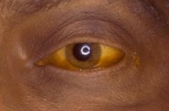 - acute hepatitis can have a wide spectrum of clinical presentations, ranging from virtually asymptomatic to fulminant liver failure
- jaundice- look first in the sclera, because this may be the first place jaundice is detected, especially in bla...