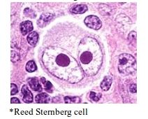 A: Reed Sternberg cell