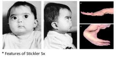 A: AD mutation of COL2A1 gene, chromosome 12, for type II collagen
A: Robin sequence, mid face hypoplasia
A: Eye – Myopia, cataracts, & retinal detachment
A: Joint – Hypermobility & enlarged joints, early arthritis, occ. spondyloepiphyseal dys...