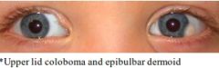 A: Most sporadic, some AD
A: Unilateral facial asymmetry, Hemifacial microsomia
A: Ocular – Upper lid coloboma, epibulbar dermoids
A: Otologic – Mild deformity to Anotia, EAC atresia, ossicular abnormalities, CHL>SNHL
A: Vertebral: Cervical fu...