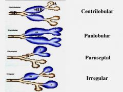 Centriacinar (centrilobular)
Panacinar  (panlobular)
Distal acinar (paraseptal)
Irregular