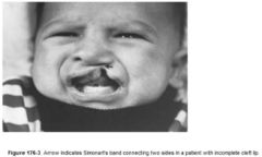 A: In an incomplete CL, bridge or bar of lip tissue of varying size that bridges the cleft gap