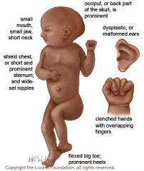 trisomy 18

Sx: severe mental retardation, rocker-bottom feet, micrognathia (small jaw), low set Ears, clenched hands, prominent occiput, congenital heart dz. 

Death usually occurs within 1 year of birth.