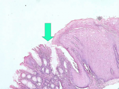 As we go down the anal canal, there is an abrupt transition from what we see throughout the length of the large intestine to NON-KERATINIZED, STRATIFIED, SQUAMOUS EPITHELIUM HERE 

verrrry abrupt. Clinically important -- site where cancers form....