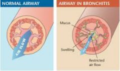 Chronic bronchitis is defined clinically as persistent cough with sputum production for at least 3 months in at least 2 consecutive years, in the absence of any other identifiable cause