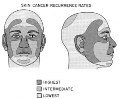 A: High risk sites for cutaneous malignancy, overlying embryonic fusion plates
3: upper lip, junction of the ala with the nasolabial fold, nasal ala, the septum, inner canthi & lower eyelids, periauricular region extending to the temple, certain s...