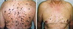 A: A shower of Seborrheic Keratoses as a sign of internal malignancy, most commonly Colonic Adenocarcinoma