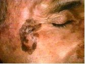 A: Lentigo Maligna, or melanoma In Situ
3: Associated with Solar damage & atypical melanocytes, Radial spread along dermal/epidermal Junction, focal Nests of cells
3: Overall probability of developing into melanoma ~5%; presence of a Nodule carrie...