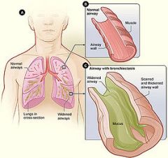 Bronchiectasis is a disorder in which destruction of smooth muscle and elastic tissue by chronic necrotizing infections leads to permanent dilation of bronchi and bronchioles. Because of better control of lung infections, bronchiectasis is now unc...