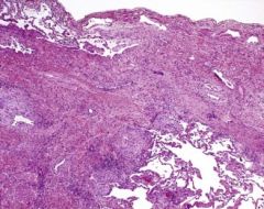 Usual interstitial pneumonia (UIP) is a form of lung disease characterized by progressive scarring of both lungs.[1] The scarring (fibrosis) involves the supporting framework (interstitium) of the lung. 


It's a HISTOLOGIC PATTERN OF fibrosis.