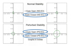 notmal stability eyes closed (NS-EC)