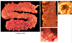 What is the age of onset of polyps in Familial Adenomatous Polyposis? Onset of colorectal cancer?