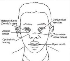 General: facial pallor, allergic shiners, mouth breathing, transverse crease on nose bridge (allergic salute)
- Dennie-Morgan lines and conjunctivitis
- Nasal mucosal swelling (bluish)
- Fluid in middle ear